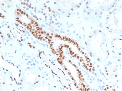 FFPE human renal cell carcinoma sections stained with 100 ul anti-PAX8 (clone PAX8/1491) at 1:300. HIER epitope retrieval prior to staining was performed in 10mM Citrate, pH 6.0.
